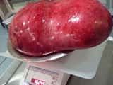 17.5 Kg Ovarian Cyst after removal