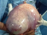 17.5 Kg Ovarian Cyst removed