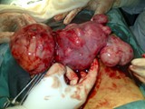 Multiple Uterine Tumour (Fibroid) 