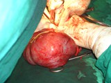 Unusual Pelvic Tumour
